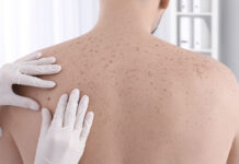 Prevención del cáncer de piel